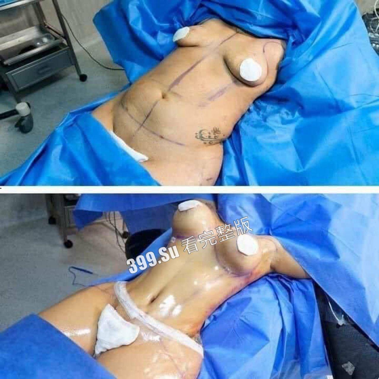 医美整形那些事儿 假的真不了  女人对自己真狠 阴唇黑了就直接切掉 （二）