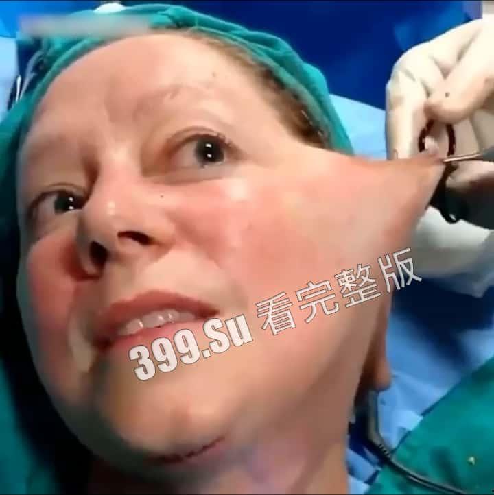 医美整形那些事儿 假的真不了 看的脸皮发麻 (三)-7